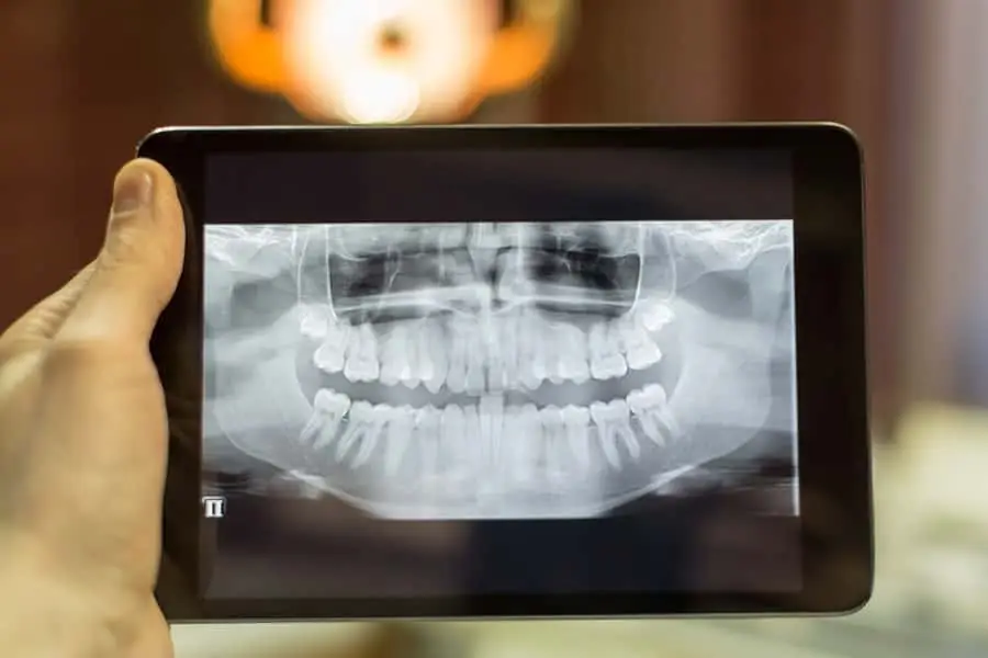 Digital X-Rays